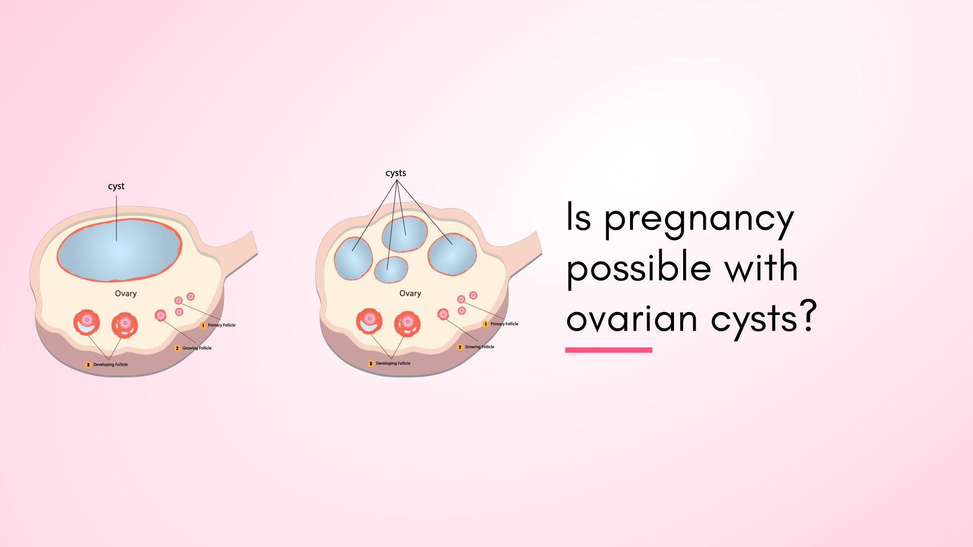 Is Pregnancy Possible with Ovarian Cysts?