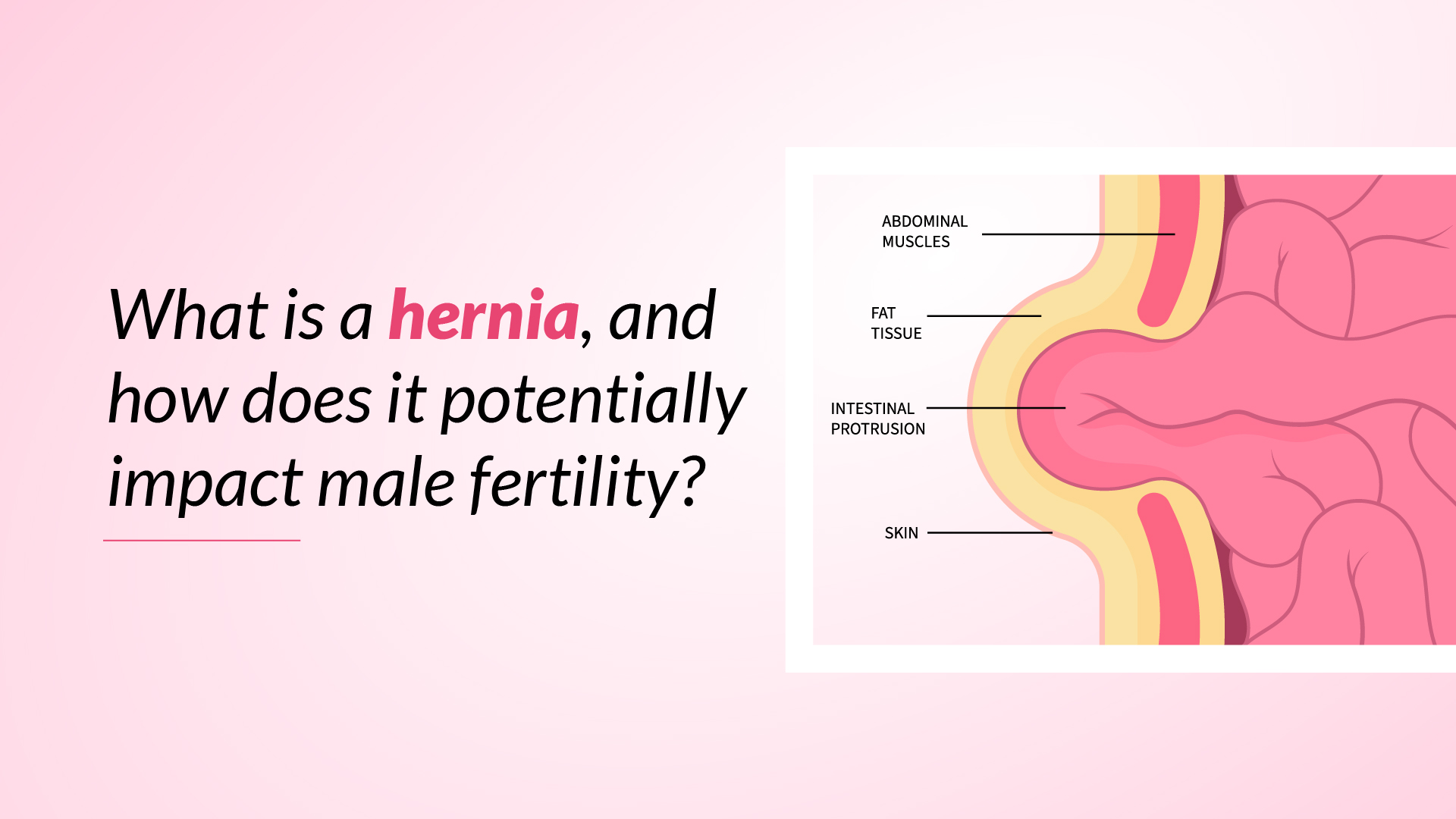 What is a Hernia, and how does it potentially impact Male Fertility