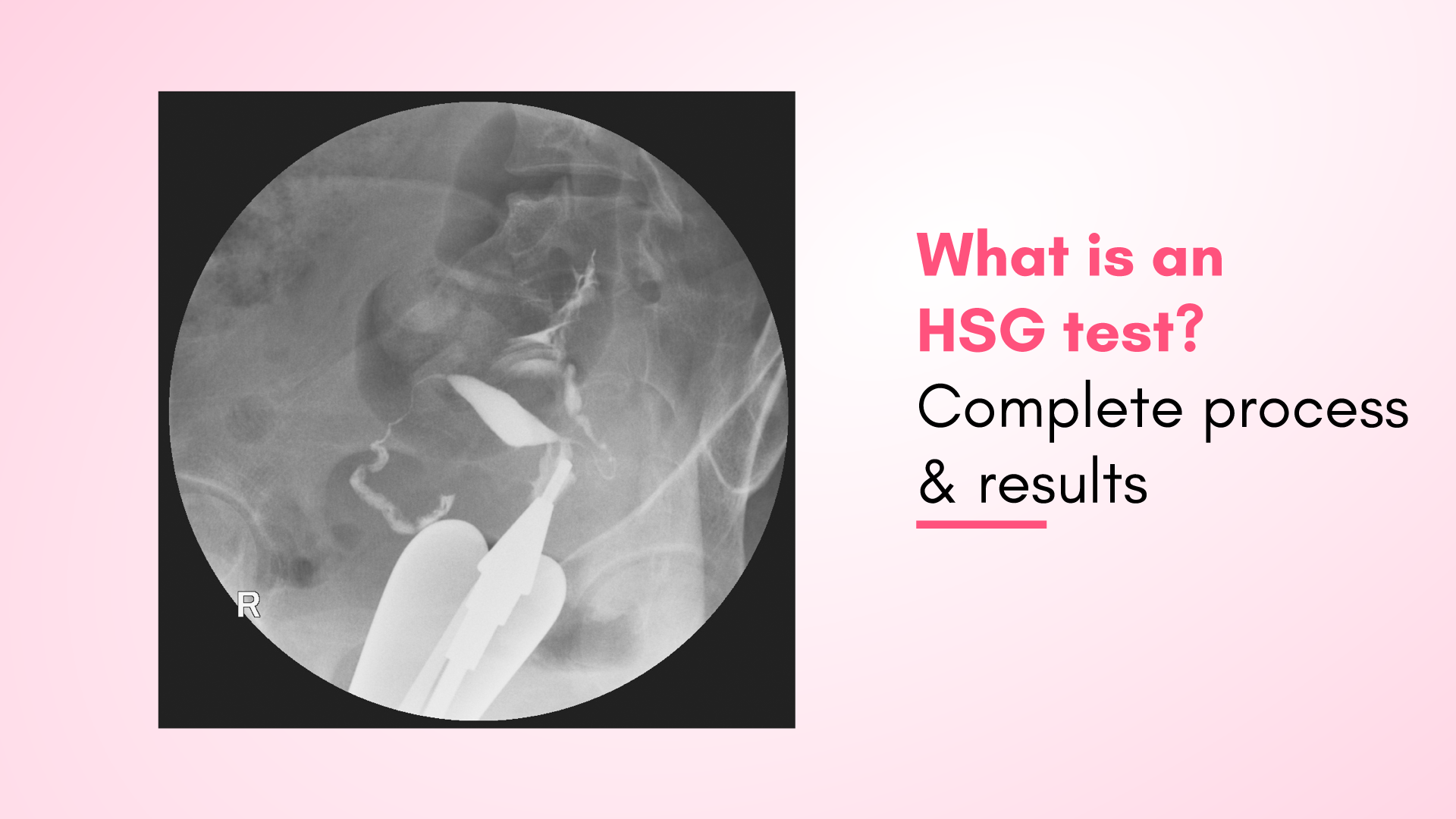 What is an HSG Test? Complete Process & Results