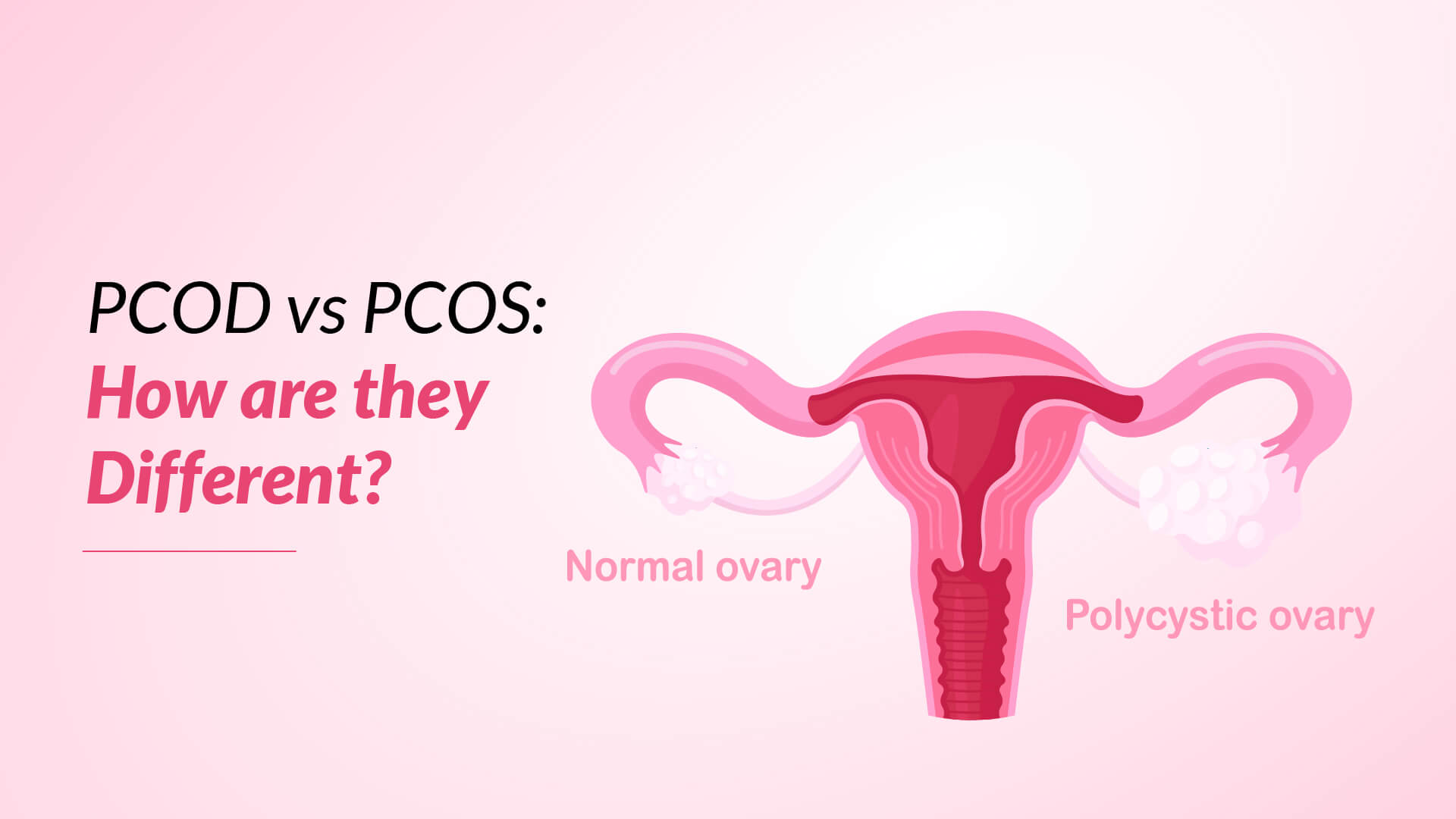 PCOD vs PCOS: How Are They Different